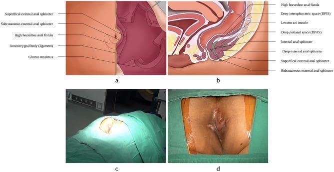 Educational medical composite depicting the anatomy and surgical context of a high horseshoe anal fistula (HHAF). Panel (a) is an anatomical diagram of the perianal region showing external landmarks including the gluteus maximus, anococcygeal body, and the subcutaneous/superficial external anal sphincters, with a dotted line delineating the HHAF scope. Panel (b) presents a sagittal pelvic diagram illustrating the internal anal sphincter, levator ani muscle, and the deep, superficial, and subcutaneous external sphincters. It highlights the deep intersphincteric space (DPIS) and deep postanal space (DPAS) in relation to the fistula tract. Panel (c) is a clinical photograph showing the patient in a prone jackknife position for surgical exposure. Panel (d) provides a close-up clinical photograph of the preoperative surgical field, where a green-shaded overlay identifies the external manifestation of the HHAF. This visual resource is designed for proctological surgical planning and provides clear anatomical orientation of complex perianal fistulas relative to the pelvic floor musculature.
