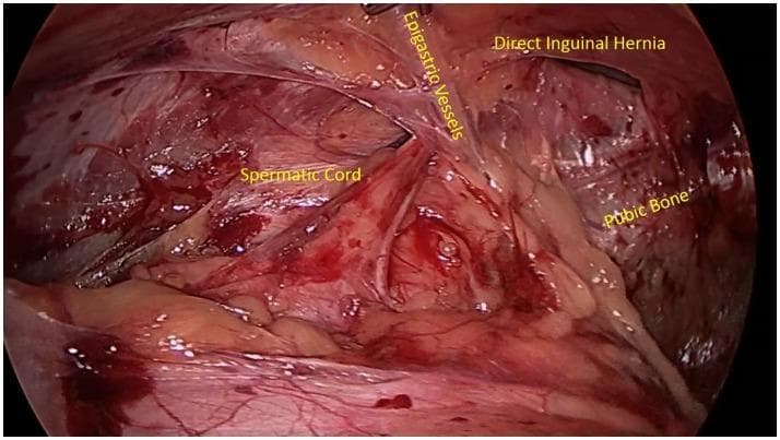 A laparoscopic (endoscopic) surgical view of the posterior inguinal abdominal wall, highlighting key anatomical landmarks for hernia identification. Centrally, the inferior epigastric vessels are visualized, serving as the critical anatomical boundary between direct and indirect inguinal spaces. Medial to these vessels (Hesselbach's triangle), a distinct bulge or protrusion is visible, identified as a direct inguinal hernia. Inferiorly, the whitish, firm structure of the pubic bone is seen, providing a caudal reference point. The spermatic cord is visible laterally, coursing toward the deep inguinal ring. The image demonstrates the laparoscopic perspective of the preperitoneal space, often utilized in TEP (Total Extraperitoneal) or TAPP (Transabdominal Preperitoneal) hernia repair procedures. This clinical photograph provides an educational example of inguinal floor weakness and the topographical relationship between the abdominal wall musculature, vasculature, and pelvic osteology in the context of general surgery and sports medicine.