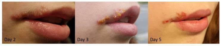 This clinical progression series consists of three photographs documenting the natural history of Herpes Labialis (cold sore) on the upper lip and oral commissure. The first panel (Day 2) illustrates the vesicular stage, characterized by clusters of small, fluid-filled, translucent blisters on an erythematous base along the vermillion border. The second panel (Day 3) depicts the transition to the weeping and crusting stage, where vesicles have ruptured and coalesced into a thicker, yellowish-brown serosanguinous crust. The third panel (Day 5) demonstrates the scab formation and early healing phase, showing a more defined, dry reddish-brown scab that has begun to contract at the edges, with some areas of re-epithelialization visible. These images serve as a primary educational resource for medical students and clinicians to recognize the dermatological morphology of labial herpes simplex virus (HSV-1) infection throughout its standard temporal evolution.