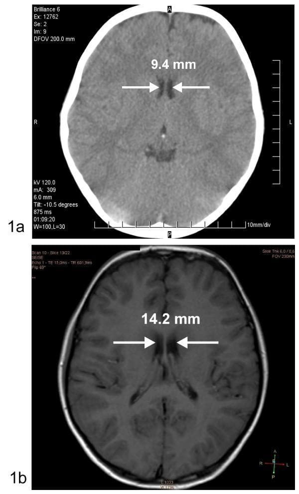This educational comparison features two axial neuroimaging views (CT and MRI) demonstrating changes in the intercaudate diameter as a marker for cerebral edema. Top Image (1a): Non-contrast axial CT scan during an acute episode of diabetic ketoacidosis (DKA). White arrows highlight a narrowed intercaudate diameter of 9.4 mm, a finding suggestive of cerebral swelling and sulcal effacement. The bone of the skull appears hyperdense (bright white), while the brain parenchyma shows lower contrast between gray and white matter. Bottom Image (1b): T1-weighted non-contrast axial MRI of the same patient after clinical recovery. The intercaudate diameter has expanded to 14.2 mm, indicating the resolution of edema. The MRI provides superior soft-tissue contrast, clearly differentiating the hypointense (dark) cerebrospinal fluid (CSF) in the ventricles from the brain parenchyma. This comparison serves as a diagnostic illustration of the radiological manifestations of cerebral edema and its subsequent resolution, emphasizing the importance of measuring ventricular dimensions like the intercaudate distance in monitoring pediatric DKA complications.