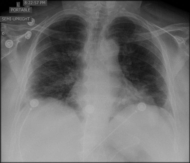 This diagnostic image is a portable, semi-upright anteroposterior (AP) chest X-ray of an adult patient. The radiograph demonstrates diffuse, bilateral pulmonary opacities and areas of consolidation. The increased density is most prominent in the middle and lower lung zones, obscuring the normal bronchovascular markings and suggesting multifocal pneumonia. External medical hardware is visible, including multiple electrocardiogram (ECG) leads positioned on the chest wall. The cardiac silhouette and mediastinal contours appear within normal limits for this projection. The trachea is midline. The visible portions of the diaphragm and costophrenic angles are partially obscured by the parenchymal opacification. This imaging presentation is clinically significant for the assessment of viral or atypical pneumonias, such as COVID-19 or influenza, which frequently present with such bilateral, diffuse infiltrates.
