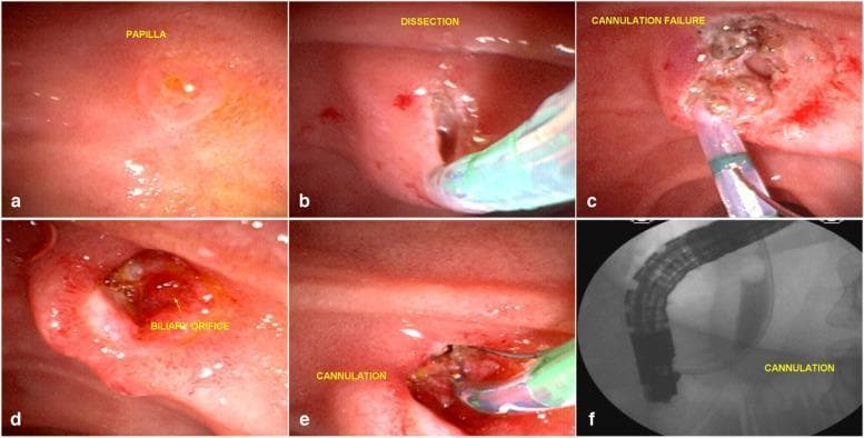 This composite figure illustrates a two-stage Endoscopic Retrograde Cholangiopancreatography (ERCP) procedure involving an endoscopic fistulotomy (EFP) to manage a difficult biliary cannulation. Image (a) presents the initial endoscopic view of a small, undisturbed major duodenal papilla. Images (b) and (c) document an unsuccessful primary attempt, showing the dissection of the infundibulum using a needle-knife (fistulotome) with longitudinal incisions, followed by failed cannulation attempts characterized by mucosal trauma and localized hemorrhage. Image (d) displays the same site six days later; the inflammatory response has subsided, and the biliary fistula orifice is clearly demarcated by green-gold bile staining. Image (e) demonstrates successful cannulation of the common bile duct (CBD) via the mature fistula using a sphincterotome and guide wire. The final panel (f) is a fluoroscopic radiogram confirming deep cannulation of the biliary tree with contrast agent opacifying the CBD. This series serves as an educational example of the 'precut' fistulotomy technique and the clinical utility of a delayed second-look approach for achieving biliary access.