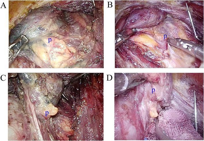 This set of four intraoperative clinical photographs (A-D) demonstrates the surgical exposure and identification of parathyroid glands (labeled 'p') during thyroid surgery, comparing the use of carbon nanoparticles (CN) for tissue contrast. Panels A and C show the inferior and superior parathyroid glands, respectively, after CN injection. In these images, the thyroid gland and surrounding lymphatic tissues exhibit dark grey or black staining due to carbon nanoparticle uptake, which provides visual contrast against the yellowish-tan, lobulated parathyroid glands that remain unstained. Panels B and D serve as control images showing inferior and superior parathyroid glands without the use of CN tracers. In the absence of CN, the parathyroid glands appear as pale yellow or ovoid structures, but the surrounding thyroid and fatty tissues maintain their natural reddish-pink and translucent hues, providing less distinct visual differentiation compared to the CN-stained groups. This educational visual illustrates the clinical application of negative mapping tracers to protect parathyroid glands during endocrine surgery by enhancing the visibility of surrounding structures.