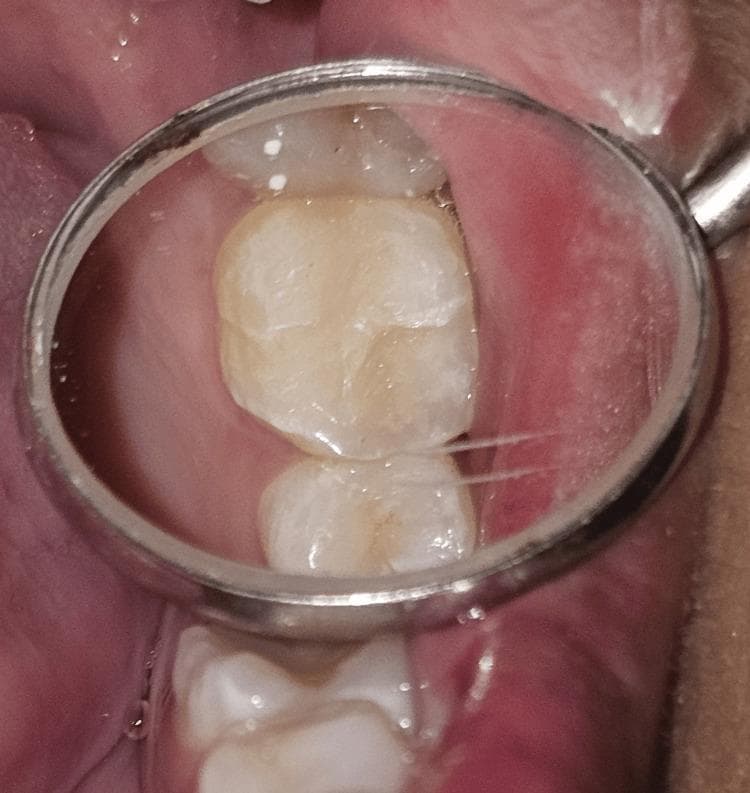 This intraoral clinical photograph, viewed through a dental mirror, displays a completed Class I composite resin restoration on the occlusal surface of tooth 26 (maxillary left first molar). The restoration illustrates the results of the 'stamp technique,' which aims to replicate the original occlusal anatomy. The composite material exhibits a shade that closely matches the surrounding natural enamel, showing a smooth surface texture and integrated margins. Primary anatomical features, including the cusps and developmental grooves, have been reconstructed to provide functional intercuspation. No significant marginal gaps, overhangs, or flash are visible at this magnification. The surrounding gingival tissues appear healthy, and the adjacent premolar and second molar are partially visible, providing anatomical context. This image serves as an educational example of conservative restorative dentistry and biomimetic reconstruction of pit and fissure caries.