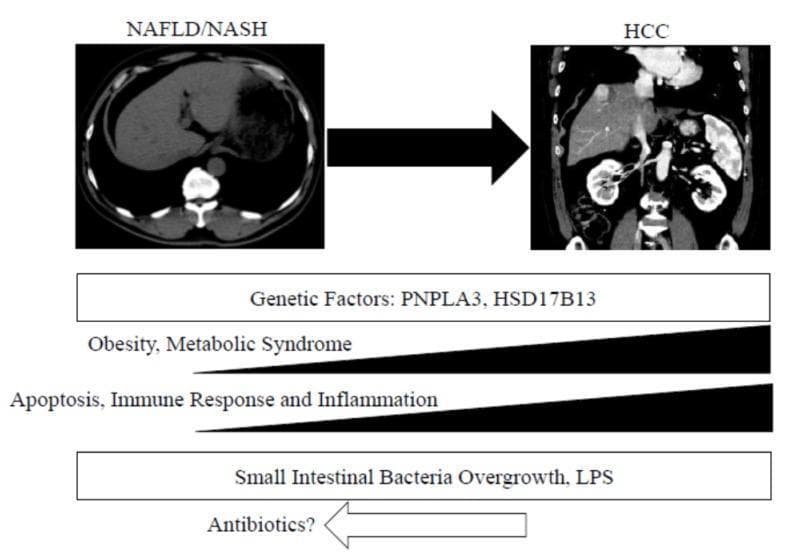 This medical infographic illustrates the pathophysiology and progression of liver disease from Nonalcoholic Fatty Liver Disease/Nonalcoholic Steatohepatitis (NAFLD/NASH) to Hepatocellular Carcinoma (HCC). The upper portion features two diagnostic CT images: an axial section of a liver with NAFLD/NASH showing diffuse decreased attenuation (steatosis) and a coronal section demonstrating HCC with multiple heterogeneously enhancing masses distorting the hepatic contour. Below the imaging, horizontal bars and arrows correlate clinical progression with underlying molecular and environmental drivers. Key factors identified include genetic predispositions (PNPLA3, HSD17B13), the increasing influence of obesity and metabolic syndrome, and escalating levels of apoptosis, immune response, and inflammation. The diagram also highlights the role of the gut-liver axis, specifically Small Intestinal Bacterial Overgrowth (SIBO) and Lipopolysaccharides (LPS), with a potential therapeutic intersection for antibiotics. The graphic serves as a summary of hepatocarcinogenesis in the context of metabolic dysfunction-associated liver disease.