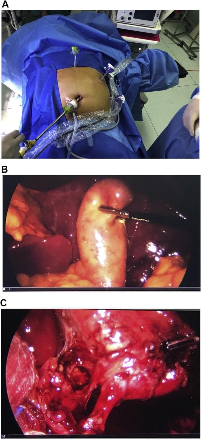 A composite medical image illustrating a laparoscopic cholecystectomy in a patient with Situs Inversus Totalis. Panel A is a clinical photograph of the patient's abdomen draped for surgery, showing a mirrored port configuration: a 10mm transumbilical port for the camera, a 10mm epigastric port, and two 5mm ports in the left upper quadrant (midclavicular and anterior axillary lines). Panels B and C are intraoperative laparoscopic views. Panel B shows the distended, inflamed gallbladder being manipulated by a grasper, located notably in the left upper quadrant due to the patient's anatomical inversion. Panel C captures the dissection of the triangle of Calot, demonstrating the 'critical view of safety' where the cystic duct and cystic artery are isolated from surrounding connective and fatty tissues before clipping. The imagery highlights the necessary technical adjustments in surgical ergonomics and port placement required when performing standard hepatobiliary procedures on patients with situs inversus.