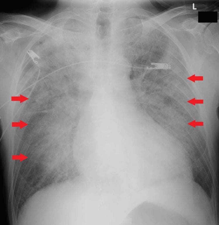 This diagnostic image is an anteroposterior (AP) chest X-ray demonstrating features of acute pulmonary edema. The most striking finding is a 'butterfly shadow' or 'bat-wing' pattern, characterized by bilateral, symmetric, ground-glass opacities predominantly in the perihilar and medullary regions of the lungs. Red arrows point to the peripheral margins of these alveolar infiltrates, where there is relatively more sparing of the cortical lung fields. The cardiac silhouette is enlarged (cardiomegaly), which, in conjunction with the central opacities, is highly suggestive of cardiogenic pulmonary edema. Visible medical support includes radiopaque electrocardiogram (ECG) leads and a central venous line or monitoring device traversing the upper thorax. The bony structures, including the ribs and clavicles, appear intact. This visual presentation is an educational example of pulmonary congestion and alveolar filling commonly seen in acute decompensated heart failure or flash pulmonary edema, particularly in patients with underlying chronic kidney disease.