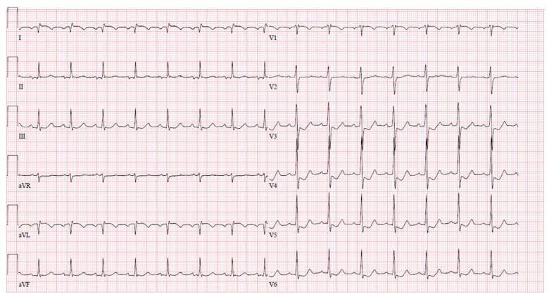 A standard 12-lead diagnostic electrocardiogram (ECG) recorded on pink grid paper, demonstrating dynamic ischemic changes consistent with unstable angina or coronary vasospasm. The tracing shows a regular sinus rhythm with narrow QRS complexes. Key pathologic findings include ST-segment elevation in high lateral leads I and aVL, accompanied by deep T-wave inversions in the same leads. Significant horizontal to downsloping ST-segment depression is visible across the precordial leads V3 through V6. These visual findings represent acute myocardial ischemia and demonstrate the reciprocal relationship often seen between lateral and precordial distributions. The educational focus is on the recognition of ST-segment morphology changes and T-wave abnormalities in a clinical critical care setting following coronary angiography.