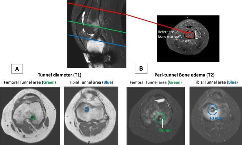 This diagnostic imaging composite illustrates the methodology for assessing graft-bone tunnel interfacial healing following ACL reconstruction. The top image shows a sagittal T2-weighted MRI of the knee with reference lines for transverse sections. Section A displays T1-weighted transverse views used to measure the bone tunnel diameter at the femoral (green circle) and tibial (blue circle) entry points. Section B utilizes T2-weighted transverse views to assess peri-tunnel bone edema. In these T2 images, circular regions of interest (ROI) with a 10 mm diameter are centered on the femoral and tibial tunnels to quantify signal hyperintensity, indicative of edema. An additional transverse view of the middle third of the femoral shaft (red circle) serves as a reference point for normal bone marrow signal intensity. This normalization allows for the objective calculation of peri-tunnel edema changes. The content is designed for orthopedic and radiological education, focusing on post-surgical ligament reconstruction monitoring and tendon-to-bone healing metrics.