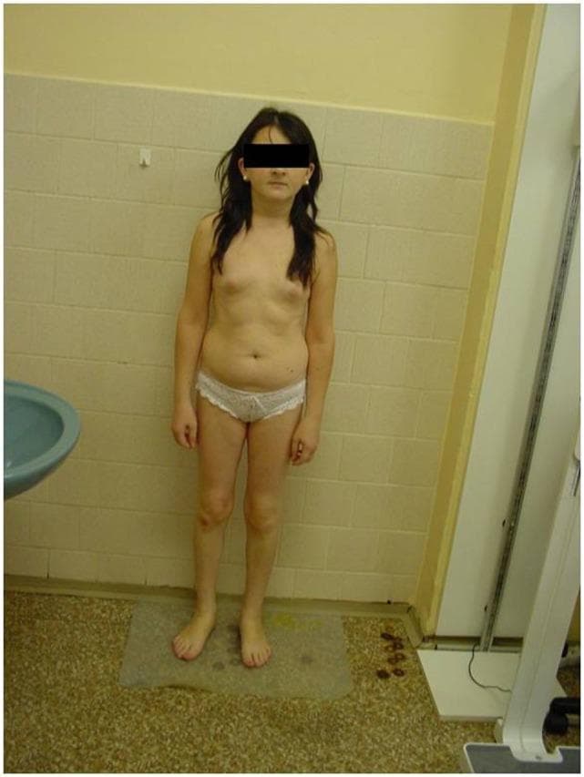 A clinical photograph shows a 27-year-old female patient with a marked childish appearance, characteristic of severe delayed puberty and primary amenorrhea. The patient exhibits short stature and a youthful facial appearance with pale, slightly puffy skin. Morphological assessment reveals significant underdevelopment of secondary sexual characteristics: the breasts are pre-pubertal (Tanner stage B1-B2), and there is an absence of axillary and pubic hair. The physique is slender with an infantile distribution of subcutaneous fat and a slightly rounded abdomen, inconsistent with chronological adulthood. This visual presentation is indicative of hypogonadotropic hypogonadism, which in this case is associated with a PROP1 gene mutation leading to combined pituitary hormone deficiency (CPHD). The photograph serves as a medical educational example of the physical manifestation of untreated pituitary insufficiency and its impact on skeletal growth and sexual maturation.