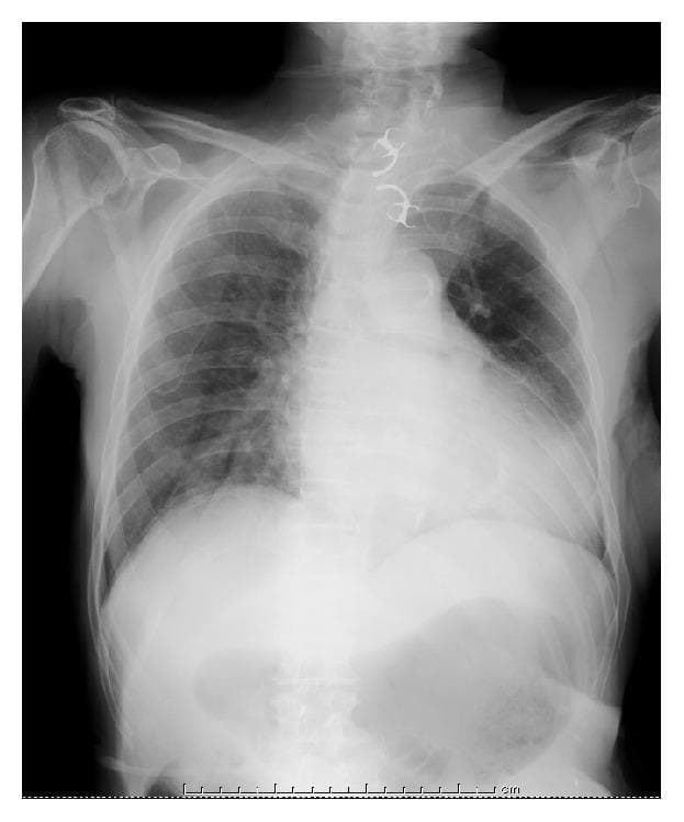 This diagnostic image is a posterior-anterior (PA) plain chest radiograph demonstrating an ingested foreign body. A highly radiopaque, 'U'-shaped object is clearly visible in the midline, localized to the upper mediastinum/cervical esophagus region, just superior to the level of the aortic arch. The object features distinct lateral radiopaque projections consistent with metallic clasps of a partial denture. The long axis of the foreign body is oriented vertically within the esophageal lumen. Anatomical landmarks include the trachea, bilateral lung fields with normal vascular markings, the cardiac silhouette, and bony structures including the clavicles, ribs, and cervical-thoracic vertebrae. The image illustrates the clinical challenge of esophageal foreign body impaction, where sharp components like denture clasps increase the risk of mucosal injury or perforation. This visual material is relevant for gastroenterology and emergency medicine education focusing on diagnostic radiology and foreign body management.