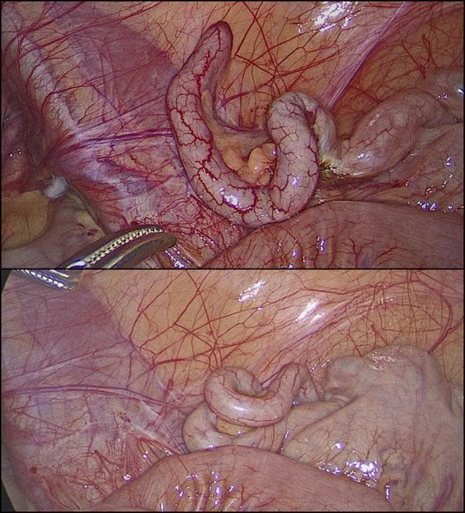 This clinical photograph consists of two laparoscopic views showing a macroscopically normal vermiform appendix during a diagnostic laparoscopy. The appendix appears as an elongated, tubular, and slightly coiled structure with a smooth, pale pink serosal surface. Fine, branching subserosal blood vessels are clearly visible across its length, indicating normal vascularity without the congestion or purulent exudate typical of acute appendicitis. In the upper frame, a laparoscopic grasper is visible, gently manipulating the appendix to facilitate inspection. The surrounding anatomy includes the mesoappendix containing adipose tissue and the glistening peritoneal lining of the right iliac fossa. There are no visual signs of inflammation, perforation, or abscess formation. This image serves as a reference for a 'grossly negative' appendix in the context of clinical suspicion of appendicitis, where symptoms may actually stem from non-inflammatory conditions such as follicular lymphoid hyperplasia or obstructive fecaliths.
