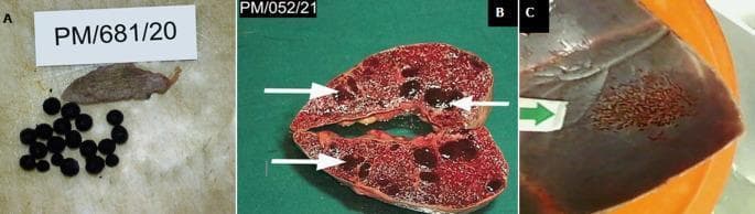 This composite of gross autopsy photographs displays pathological findings in Sickle Cell Disease (SCD) patients. Panel A shows an autosplenectomy specimen, characterized by a severely shrunken, fibrotic splenic remnant (approximately 5x3x1cm) alongside numerous dark, ovoid pigment gallstones (bilirubinate stones), which are common complications of chronic hemolysis. Panel B presents a sagittal cut section of a moderately enlarged spleen containing multiple, well-circumscribed, dark brown to black regenerative nodules (white arrows). These represent sites of extramedullary hematopoiesis, where the body attempts to compensate for chronic anemia. Panel C illustrates a gross specimen of the skull vault, where a green arrow points to a localized region of cortical bone thinning and irregular bone resorption. This reflects bone marrow expansion and compensatory remodeling of the calvarium typical in SCD. Collectively, these images demonstrate multi-organ manifestations of chronic hematologic stress, including splenic atrophy, biliary complications, and skeletal changes, pertinent to medical education in pathology and hematology.