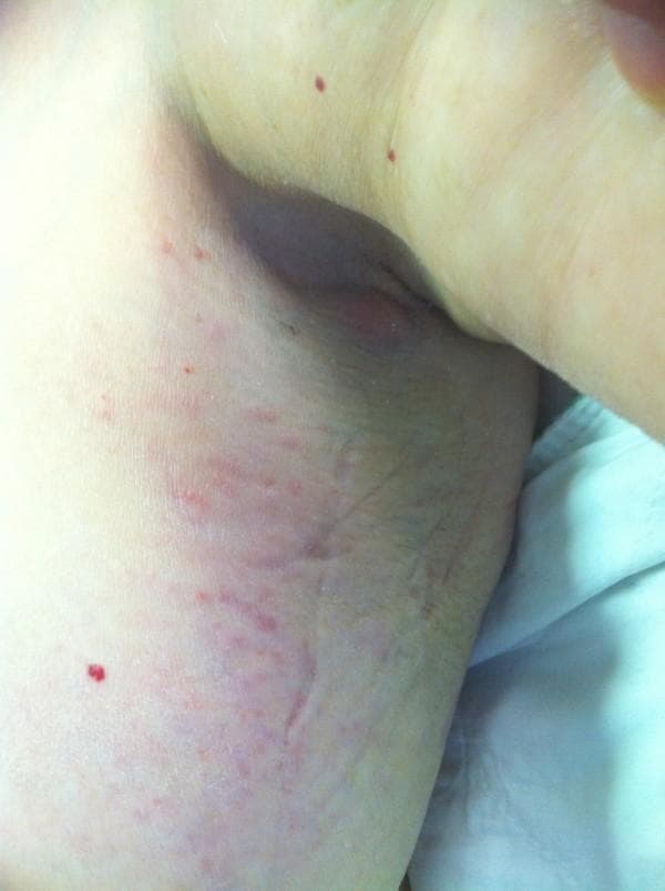 This clinical photograph displays a close-up view of the left breast upper outer quadrant and the left axillary region. The image demonstrates significant dermatological findings including diffuse erythema (redness) and pronounced soft tissue edema (swelling), which distorts the normal anatomical contours of the axillary fold. The skin surface exhibits an uneven texture with areas of thickening and subtle wrinkling, consistent with peau d'orange or inflammatory infiltration. Scattered across the erythematous region are several pinpoint petechiae or small angiomatous red spots. These findings are clinically significant as they can represent an inflammatory presentation of breast malignancies, such as inflammatory breast cancer or, as in this specific clinical context, primary breast lymphoma. The image serves as an educational example of how systemic or malignant processes can manifest with localized skin changes mimicking cellulitis or mastitis.