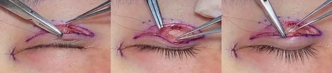 This composite of three clinical photographs captures key intraoperative steps of an upper eyelid blepharoplasty. The images show a surgical field with purple antiseptic marking lines delineating the supratarsal crease. A needle holder and fine forceps are visible, manipulating tissues within a partial-thickness incision. The primary educational focus is the formation of a tarsus linkage mechanism, where a 7-0 nylon suture is passed through the orbicularis oculi muscle and the tarsal plate to facilitate the creation of a stable double eyelid fold. In the central frame, the removal of pre-tarsal fascia and herniated orbital fat is demonstrated, exposing the deeper anatomical layers. The transparent monofilament sutures are used both for internal tissue fixation (levator aponeurosis-tarsus-orbicularis-skin linkage) and subsequent skin closure. This visual illustrates a specialized technique in plastic and reconstructive surgery aimed at achieving aesthetic eyelid contouring and reinforcing structural adhesion during scar healing.