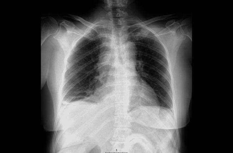 A posteroanterior (PA) thoracic X-ray displaying the lungs, heart, and bony structures of the chest. The primary diagnostic finding is a blunted right costophrenic angle with a faint band of opacification layering superiorly and laterally along the chest wall, consistent with a small, free-flowing right-sided pleural effusion. The left costophrenic angle remains sharp and clear. The bilateral lung fields are otherwise largely lucent without evidence of focal consolidation, masses, or interstitial edema. The bronchovascular markings are normal in distribution. The mediastinal silhouette is midline and of normal width, and the cardiac silhouette shows a normal size and configuration for this projection. The trachea is centrally located, and the visualized skeletal structures, including the ribs and clavicles, appear intact. This diagnostic image is used in medical education to illustrate the subtle early radiographic signs of pleural fluid accumulation, which in this clinical context was the initial manifestation of an underlying pleural malignancy.