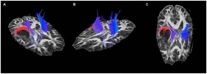This diagnostic image set presents pre-operative Diffusion Tensor Imaging (DTI) fiber tractography overlaid on axial and oblique T1-weighted anatomical brain MRI slices. The visualization displays white matter pathways, specifically the corona radiata and sensorimotor tracts, categorized into blue and red colored fiber bundles. Panel (A) and (C) demonstrate a pathologic state in the right hemisphere where a visible astrocytoma causes significant mass effect. The red-colored fiber tracts are clearly displaced, exhibiting a curved morphology as they course around the posterior-superior aspect of the tumor. Concurrently, the blue-colored tracts in these panels show signs of distortion and compression adjacent to the lesion. In contrast, Panel (B) serves as a comparison showing the unaffected left hemisphere, where the blue fiber tracts maintain a normal anatomical distribution and vertical orientation without the lateral displacement or color-coded bundle deviation seen in the right hemisphere. This DTI study illustrates the clinical significance of tractography in preoperative planning, specifically for identifying the relationship between critical motor/sensory white matter pathways and infiltrative brain tumors.