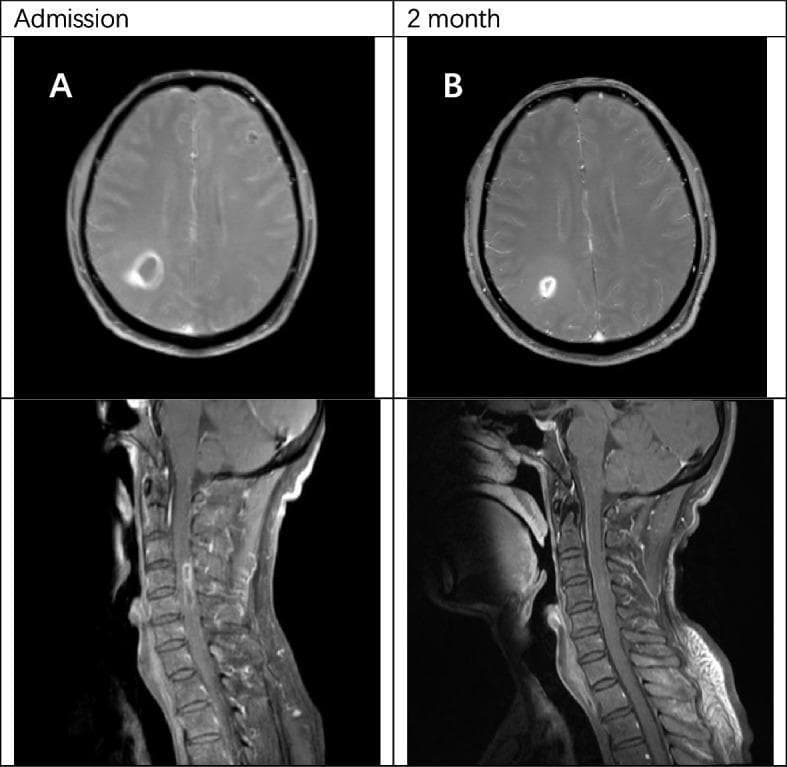 This diagnostic image comparison displays axial brain MRIs and sagittal cervical spinal cord MRIs from a patient with central nervous system infection, likely secondary to infective endocarditis. Panel A (Admission) illustrates post-contrast T1-weighted images showing a prominent ring-enhancing lesion in the right parietal lobe of the brain and a similar ring-enhancing lesion within the spinal cord at the C4-C5 level, accompanied by surrounding edema. Panel B (2 months) demonstrates the follow-up imaging after a course of antibiotic therapy, including ceftriaxone and linezolid. Visually, there is a significant reduction in the size and enhancement intensity of both the cerebral and spinal cord abscesses, indicating a positive response to treatment. The imaging highlights the classic radiological appearance of pyogenic abscesses, characterized by peripheral rim enhancement and central necrosis, and emphasizes the importance of longitudinal neuroimaging in monitoring therapeutic efficacy in infectious CNS diseases.