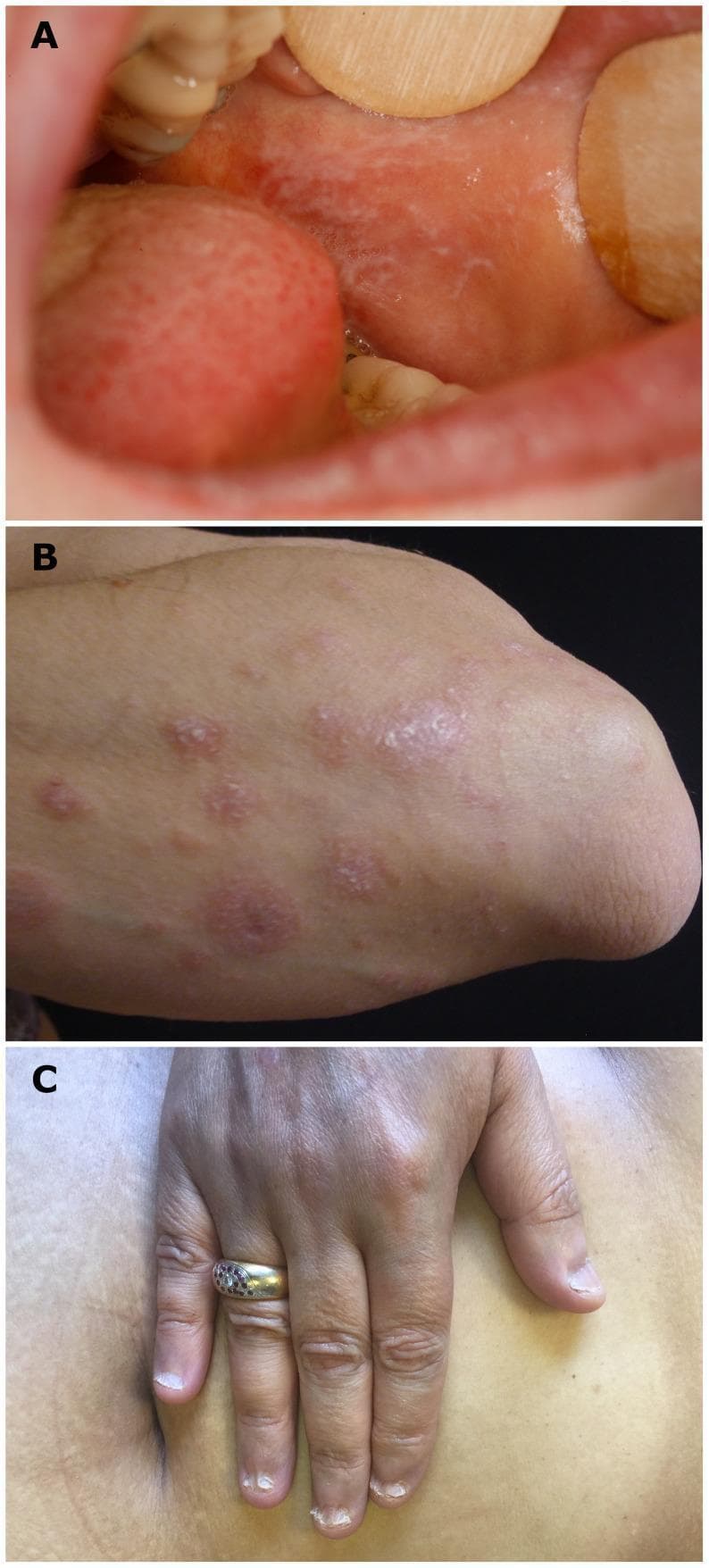This composite clinical photograph illustrates characteristic clinical manifestations of lichen planus (LP) across mucosal, cutaneous, and ungual sites. Panel A displays a reticular pattern of lacy, white interconnected lines known as Wickham striae on the buccal mucosa, typical of oral lichen planus. Panel B shows the cutaneous presentation on a forearm, featuring multiple well-demarcated, violaceous, flat-topped polygonal papules; close inspection reveals the presence of surface Wickham striae. Panel C demonstrates lichen planus onychodystrophy, specifically showing pterygium formation where the proximal nail fold has fused with the nail bed, leading to splitting and destruction of the nail plate. These images serve as a teaching reference for the diagnostic 'P's' of lichen planus (purple, polygonal, planar, pruritic, papules, and plaques) and the multisystem involvement of the condition in dermatology and oral medicine.