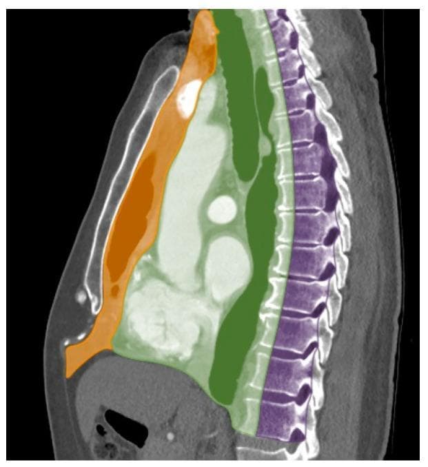 This diagnostic anatomical diagram features a sagittal reformatted computed tomography (CT) scan of the thorax with a color-coded overlay illustrating the International Thymic Malignancy Interest Group (ITMIG) classification system for mediastinal compartments. The image delineates three distinct zones: 1) The Prevascular (Anterior) Compartment, highlighted in orange, which is bounded anteriorly by the sternum and posteriorly by the pericardium and great vessels; it includes the thymic bed. 2) The Visceral (Middle) Compartment, highlighted in green, which encompasses the heart, trachea, and esophagus, extending from the posterior border of the prevascular space to the anterior aspect of the vertebral bodies. 3) The Paravertebral (Posterior) Compartment, highlighted in purple, which covers the paraspinal regions and the spine. This visual aid is designed for radiology and thoracic surgery education to facilitate the accurate localization of mediastinal masses, such as thymomas, lymphomas, or neurogenic tumors, which is the primary step in developing a clinical differential diagnosis.