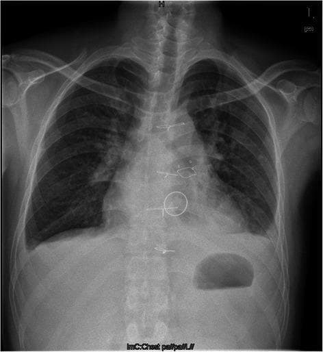 This diagnostic image is a posterior-anterior (PA) chest radiograph showcasing a postoperative state following double valve replacement. The thoracic cavity reveals several key surgical features: radio-opaque sternal wires are visible along the midline, indicating a recent median sternotomy. Within the cardiac silhouette, two prosthetic valves are identified by their distinct radiographic densities and positions. A mechanical valve, characterized by high radio-opacity, is located in the mitral valve position. Superior and slightly anterior to this is a bioprosthetic valve in the pulmonary position, visualized as a less dense, thin radio-opaque ring. The heart appears moderately enlarged (cardiomegaly), and there is a visible increase in bronchovascular markings within the lung fields, consistent with postoperative changes or underlying rheumatic heart disease pathology. Key anatomical landmarks include well-defined clavicles, ribs, and a visible gastric air bubble below the left hemi-diaphragm. This image serves as an educational example of postoperative imaging for complex valvular heart disease and the radiographic differentiation between mechanical and biological prostheses.