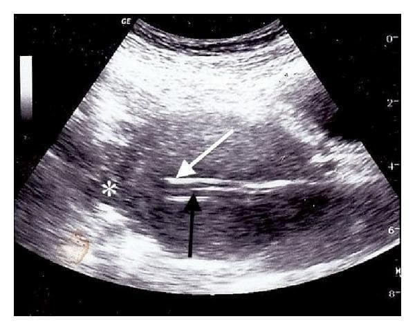 This diagnostic image is a transabdominal ultrasound in the sagittal plane, demonstrating ultrasound-guided intrauterine instrumentation. The scan shows two distinct, hyperechoic linear structures entering the uterine cavity. A white arrow identifies a suction curette, which is seen threaded over a secondary hyperechoic linear guide, indicated by a black arrow as a 10-French intubating stylet. A white asterisk (*) marks the uterine fundus, the intended anatomical destination within the uterine cavity. The surrounding myometrium and pelvic tissues exhibit heterogeneous echogenicity with characteristic speckled artifact. The image illustrates a clinical technique used to navigate difficult anatomy or false tracts (such as uterine perforation sites) by using a shaped stylet as a guide for the curette. This educational visual is relevant for obstetrics and gynecology, specifically regarding complications and management during surgical abortion or dilation and curettage (D&C) procedures.