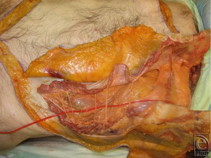 This clinical anatomical photograph shows a deep surgical dissection of a human cadaver's right thoracoabdominal region, illustrating the procurement of an osteomyofasciocutaneous allograft. The image reveals a 6-cm segment of the chest wall including three vertebrochondral ribs that have been completely released; their cross-sections clearly show the internal bone marrow. The rectus abdominis muscle remains attached to the inferior aspect of these ribs. Segmental intercostal thoracolumbar nerves are visible as thin, longitudinal cords traversing the plane between the internal oblique and transversus abdominis layers. A red latex-injected blood vessel (representing the deep inferior epigastric or internal mammary system) is highlighted, demonstrating its anatomical course. Adipocutaneous flaps and underlying muscle fascia are reflected to expose the deep surgical field. This specimen demonstrates the surgical anatomy necessary for functional abdominal wall transplantation and complex reconstructive surgery involving neurovascular and bony components.