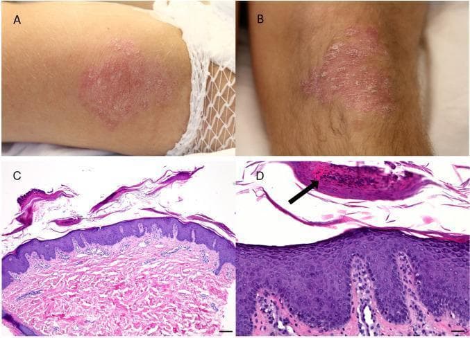 A multi-panel medical image illustrating the clinical and histological features of psoriasis. Panels A and B are clinical photographs showing well-demarcated, erythematous, scaly plaques located on the extensor surfaces of the elbows and knees. Panels C and D are photomicrographs of a skin biopsy stained with Hematoxylin and Eosin (H&E). Low-power magnification (C) demonstrates classic psoriasiform acanthosis, characterized by regular epidermal hyperplasia with elongated rete ridges and perivascular lymphocytic infiltration in the upper dermis. High-power magnification (D) reveals parakeratosis (retention of nuclei in the stratum corneum), dilated and tortuous capillary vessels within the papillary dermis, and a Munro microabscess—a distinct collection of neutrophils within the stratum corneum (indicated by a black arrow). The combination of clinical distribution on extensor surfaces and hallmark histological findings supports a diagnosis of psoriasis vulgaris, presented here in the context of a paraneoplastic manifestation of thymic carcinoma.