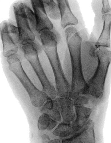 This intraoperative fluoroscopic image (X-ray) depicts the skeletal anatomy of the human hand and wrist, with a primary focus on the carpus and metacarpal region during a surgical suspension procedure. The image shows the five metacarpals, carpal bones including the scaphoid and capitate, and the proximal phalanges. A notable feature is the absence or surgical alteration of the trapezium, characteristic of a trapeziectomy for the treatment of basal joint (thumb CMC) arthritis. The first metacarpal is positioned in relative opposition to the second metacarpal. Bone density and alignment of the remaining carpal and metacarpal structures appear normal within the surgical context. This diagnostic and interventional image serves as a clinical reference for orthopedic hand surgery, illustrating the anatomical space created and the alignment maintained between the first and second metacarpals following trapezial resection and suspensionplasty.