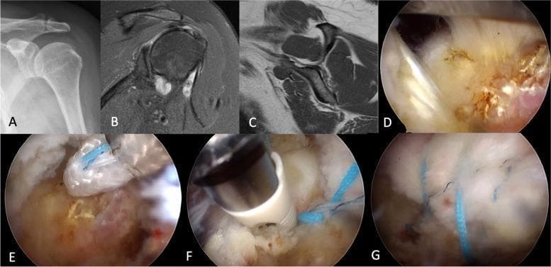 This composite figure illustrates the preoperative evaluation and intraoperative stages of a transosseous-equivalent suture-bridge (TOE-SB) repair for a supraspinatus rotator cuff tear. Panel A shows a plain X-ray of the shoulder. Panels B and C provide MRI views (axial and sagittal) displaying the soft tissue pathology and muscle quality. Panels D through G are arthroscopic intraoperative photographs detailing the surgical progression: (D) Visualization of a crescent-shaped supraspinatus tear at the footprint; (E) Insertion of an all-suture anchor into the medial row to establish the primary anchor point; (F) Fixation of sutures from the medial row to the lateral aspect of the greater tuberosity using knotless anchors; and (G) The final reconstructive construct, showing the completed suture bridge compressing the tendon back to its anatomical footprint. This material is designed for orthopedic surgical education, focusing on arthroscopic shoulder stabilization and rotator cuff repair techniques.