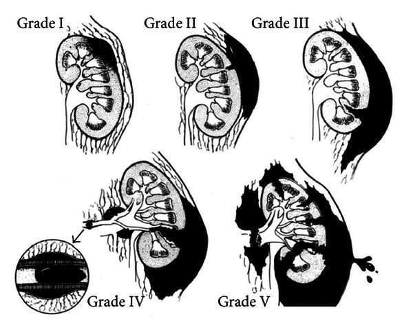 An anatomical illustration depicting the American Association for the Surgery of Trauma (AAST) Organ Injury Severity Scale for renal trauma, classified from Grade I to Grade V. The diagram uses cross-sectional views of the kidney to show progressive anatomical disruption. Grade I: Displays a subcapsular hematoma and renal contusion without laceration. Grade II: Shows a superficial parenchymal laceration (less than 1 cm depth) confined to the cortex. Grade III: Illustrates a deeper parenchymal laceration (greater than 1 cm) without involvement of the collecting system. Grade IV: Depicts a laceration extending through the cortex, medulla, and into the renal collecting system, accompanied by vascular injury and a segmental hematoma (an inset highlights the vascular thrombus). Grade V: Features a 'shattered kidney' with multiple major lacerations, devascularization, and complete avulsion of the renal hilum with extensive hemorrhage. This educational chart serves as a standardized reference for urological and trauma surgery to guide clinical management and surgical intervention.