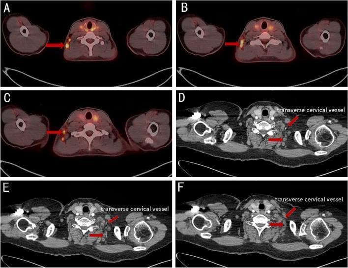 This composite of diagnostic images demonstrates the anatomical localization and metabolic activity of metastatic lymph nodes in the neck. Panels A-C show fused PET/CT axial slices where red arrows highlight hypermetabolic (FDG-avid) nodes in the posterior triangle (Level V, lateral supraclavicular group). These nodes are positioned laterally to the cervical vertebrae and deep to the trapezius muscle. Panels D-F are axial CT scans at slightly lower levels, using red arrows and text labels to identify the transverse cervical vessels. These vascular structures serve as critical surgical and radiological landmarks in the lateral neck, situated between the scalene muscle bundle medially and the omohyoid muscle laterally. The comparison illustrates the distribution of supraclavicular lymph node metastasis, often occurring in patients with extensive axillary nodal involvement from breast cancer. The images emphasize the relationship between metastatic deposits and the regional neurovascular bundle within the supraclavicular fossa, aiding in clinical target volume (CTV) delineation for radiotherapy.