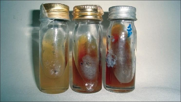This clinical diagnostic image displays three cylindrical glass culture bottles containing Sabouraud's dextrose agar (SDA) slants, used for the isolation and identification of fungal pathogens. The center and right bottles contain patient specimens identifying Madurella mycetomatis, while the left bottle serves as a control. The active fungal cultures exhibit characteristic leathery, light gray to white surface colonies. A hallmark diagnostic feature is the production of a dark brown diffusible pigment that stains the normally translucent yellow agar to a deep red-brown or brownish-black hue. This visual presentation is indicative of Eumycetoma, a chronic subcutaneous fungal infection. The bottles are sealed with metallic screw-top lids (gold and silver-toned), and the third bottle contains a blue marking for identification. Such cultures are essential in differentiating between actinomycotic and eumycotic mycetoma based on colonial morphology and pigment production.