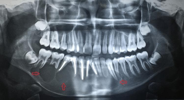 This diagnostic image is an orthopantomogram (OPG) or panoramic radiograph of the human mandible and maxilla. The central finding is a large, well-defined multilocular radiolucency with a characteristic 'soap bubble' appearance, prominently highlighted by red arrows. The lesion involves a significant portion of the mandibular body, extending bilaterally across the symphysis from approximately the lower left first premolar (tooth 34) to the lower right second molar (tooth 47). Notable secondary effects include the obliteration of root apices for teeth 31 through 34 and 41 through 46, and significant thinning of the inferior cortex of the mandible. Several anterior teeth exhibit endodontic filling material. The radiographic presentation is highly suggestive of an odontogenic tumor, such as an ameloblastoma. The image demonstrates key concepts in dental radiology, including multilocular lesion morphology, root resorption, and cortical thinning, serving as a critical educational example for oral and maxillofacial pathology.