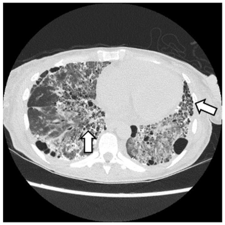This diagnostic image is an axial computed tomography (CT) scan of the chest at the level of the lower lung fields, demonstrating advanced interstitial lung disease (ILD) with a pattern consistent with Usual Interstitial Pneumonia (UIP). Key visual features include extensive honeycombing, characterized by clusters of cystic airspaces with thick, well-defined walls, and coarse reticular opacities. The distribution is predominantly subpleural and basal, as indicated by the white arrows. Significant architectural distortion is present, with evidence of traction bronchiectasis (dilated airways within fibrotic regions). The lung parenchyma shows a heterogeneous density, with ground-glass opacities interspersed among areas of terminal fibrosis. These findings are clinically significant in the context of antisynthetase syndrome (ASyS) with anti-Jo-1 positivity, illustrating the severe fibrotic pulmonary manifestations that can occur in inflammatory myopathies. The image serves as an educational example of advanced pulmonary fibrosis and the UIP radiologic phenotype.