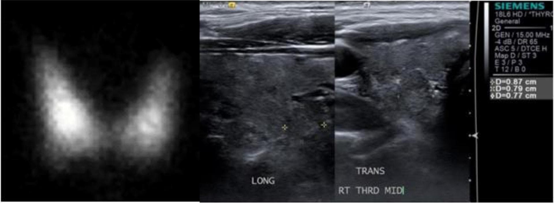 The image presents a dual-modality clinical comparison of the thyroid gland, featuring a nuclear medicine I-123 uptake scan and a grayscale ultrasound. On the left, the I-123 thyroid scan demonstrates diffusely increased radioactive tracer uptake across both the right and left lobes, with a prominent 'hot' nodule located in the right lower lobe showing focal hyper-accumulation. On the right, longitudinal (sagittal) and trans-axial (transverse) ultrasound views of the same patient correspond to the scintigraphic findings. The ultrasound images identify a heterogeneously solid nodule in the right lobe, demarcated by calipers with recorded dimensions of 0.87 cm x 0.79 cm x 0.77 cm. This composite illustrates a diagnostic workup for hyperthyroidism, comparing functional metabolic activity (scintigraphy) with anatomical structural morphology (ultrasound). The visual evidence is consistent with Marine-Lenhard syndrome or autonomous functioning thyroid nodules in the setting of iodine-induced thyrotoxicosis.