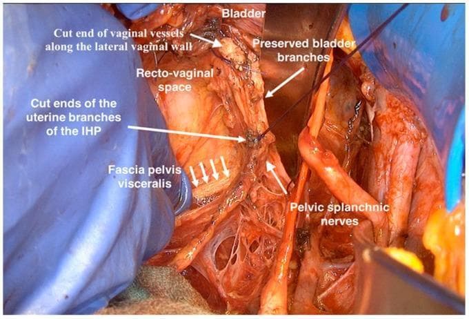 This clinical photograph captures an intraoperative view of a nerve-sparing radical hysterectomy, focusing on the dissection of the inferior hypogastric plexus (IHP) within the female pelvis. The image demonstrates the surgical preservation of autonomic neural structures following the resection of the uterus. Key anatomical landmarks and neurovascular structures are labeled: the bladder is visible superiorly, with preserved bladder branches of the IHP extending towards it. The recto-vaginal space is exposed, showing the cut ends of the vaginal vessels along the lateral vaginal wall. Inferior to these, the cut ends of the uterine branches of the IHP are identified. Deep to these structures, the fascia pelvis visceralis is highlighted by parallel arrows. On the lateral aspect, the pelvic splanchnic nerves are visible as cord-like structures emerging from the sacral roots. This visual serves as a critical educational resource for gynecologic oncology, illustrating the precise spatial relationships required to maintain pelvic autonomic function while achieving surgical margins in radical pelvic surgery.