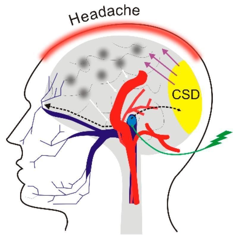 This pathophysiology diagram illustrates the hypothetical mechanism of a migraine attack in a profile view of the human head. The process begins with an external trigger (represented by a green lightning bolt) that activates the trigeminal nerve (dark blue), specifically targeting the trigeminal nucleus (light blue oval). Waves of depolarization (black dashed arrows) propagate along the nerve pathways, reaching the cerebral cortex and initiating Cortical Spreading Depression (CSD), visualized as a yellow posterior region. This activity triggers neurogenic inflammation, represented by gray 'cloud' shapes across the cortex. The subsequent release of inflammatory neurotransmitters (white arrows) leads to the vasodilation of intracranial blood vessels (bright red). The culmination of these vascular and neurological events results in the clinical manifestation of pain, indicated by a red 'Headache' arc over the superior aspect of the skull. This anatomical illustration integrates concepts of neurology and pain management, highlighting the interaction between the trigeminal vascular system and cortical activity in migraine pathogenesis.
