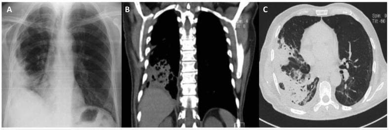 A composite of three clinical diagnostic images illustrating necrotizing pneumonia in the right lung. (A) Posteroanterior chest X-ray shows a large, heterogeneous opacity in the right basal region with ill-defined borders, indicating consolidation. (B) Coronal CT scan in mediastinal window demonstrates a hyperdense area in the right lower lobe consistent with lung consolidation, featuring internal low-attenuation areas suggestive of tissue breakdown or early cavitation. (C) Axial CT scan in lung window reveals a large, peripheral pulmonary opacity in the right lung with intimate pleural contact. The opacity exhibits internal air-filled lucencies and a distinct central cavitation, characteristic of necrotizing pneumonia and pulmonary abscess formation. This series is an educational example of progressive infectious lung disease, highlighting the transition from radiographic opacification to CT-confirmed cavitation and parenchymal necrosis. Key concepts include imaging signs of consolidation, cavitation, and pleural involvement in lower respiratory tract infections.