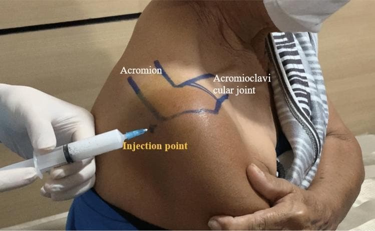 This clinical photograph demonstrates the procedural landmarks for a posterior approach subacromial corticosteroid injection in a human shoulder. The image displays the posterior and lateral aspect of a patient's shoulder with surface anatomy clearly delineated in blue ink. Key anatomical landmarks are labeled, including the 'Acromion' (specifically the posterolateral corner) and the 'Acromioclavicular joint' located superiorly. A specific 'Injection point' is marked with a small cross, situated approximately 2 cm inferior and 2 cm medial to the posterolateral acromial corner. A clinician's gloved hand is shown holding a syringe filled with a white, opaque suspension (consistent with a corticosteroid like triamcinolone acetonide). The needle tip is positioned precisely at the designated injection point, oriented at approximately a 45-degree angle to access the subacromial space. This visual serves as an educational guide for orthopedic or rheumatologic procedures, emphasizing aseptic technique and landmark-guided needle placement for treating subacromial impingement syndrome.