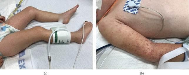 Two clinical photographs demonstrate a diffuse, nonblanching rash in a pediatric patient. Figure (a) shows the lower extremities with scattered, reddish-purple maculopapular lesions and petechiae extending to the feet. A blood pressure cuff is visible on the right lower leg. Figure (b) provides a detailed view of the upper extremity and trunk, highlighting a high density of petechiae and purpura, particularly concentrated in the area previously compressed by a blood pressure cuff (positive Rumpel-Leede phenomenon). The lesions are small, erythematous to violaceous, and distributed across the trunk and arm. The clinical presentation is highly suggestive of systemic vasculitis or severe infection, such as Rocky Mountain Spotted Fever or meningococcemia, characterized by microvascular injury and capillary fragility. The educational focus is on identifying petechial morphology and the provocation of lesions by localized pressure in critically ill patients.
