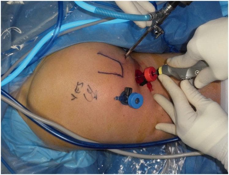 This clinical photograph demonstrates the positioning and portal placement for an endoscopic repair of a proximal hamstring avulsion. The patient is in a prone position, with the posterior hip region surgically prepared and draped. Visible on the skin are preoperative markings, including a 'U' shape likely delineating the ischial tuberosity and site verification markers. Two primary surgical portals are identified by color-coded cannulas: a superior medial portal with a red cannula containing an arthroscope for visualization, and an inferior distal portal with a blue cannula through which an oscillating shaver is being maneuvered by a gloved hand. This setup allows for sub-muscular dissection, debridement of devitalized tissue from the ischial tuberosity, and subsequent suture anchor placement for tendon reattachment. The procedure is orthopaedic in nature, focusing on sports medicine and minimally invasive techniques for managing deep gluteal space pathology and hamstring origin injuries.
