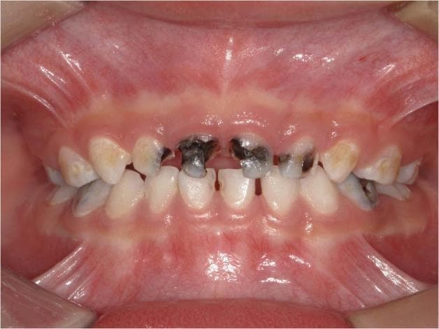 This clinical photograph displays a frontal intraoral view of the primary dentition in a pediatric patient, illustrating severe Early Childhood Caries (ECC). The maxillary anterior teeth are most severely affected, showing extensive cavitation, structural loss, and dark brown to black necrotic decay, particularly involving the central and lateral incisors. The crowns of several teeth appear eroded and irregular in shape. Yellowish and white-spot demineralization is visible on adjacent teeth, indicating varying stages of the caries process. The mandibular teeth appear less involved but show some early lesions. The surrounding gingival tissue is generally pink with relatively healthy margins and no overt signs of acute inflammation or abscess formation visible in this frame. This image serves as a classic educational example of the progression of severe early childhood caries (formerly known as baby bottle tooth decay) and its characteristic distribution patterns in the primary dentition.
