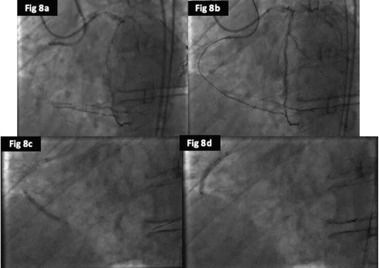 This composite of diagnostic images contains four panels (Fig 8a-d) showing a percutaneous coronary intervention (PCI) procedure for in-stent restenosis (ISR). Panel 8a is a coronary angiogram of the right coronary artery (RCA) displaying a complete occlusion within a previously placed proximal stent. Retrograde collateral vessels are visible, arising from the left coronary artery to supply the distal RCA. Panel 8b illustrates the successful antegrade advancement of a guidewire across the occluded segment into the distal vessel, confirmed via contralateral injection. Panels 8c and 8d demonstrate the therapeutic phase of the procedure, featuring predilatation of the occluded stented segment using non-compliant balloons. The balloons are seen fully inflated across the lesion site to restore luminal patency before further definitive treatment. This series provides a clinical example of managing complex chronic total occlusions within previously stented segments using antegrade techniques and high-pressure balloon angioplasty.