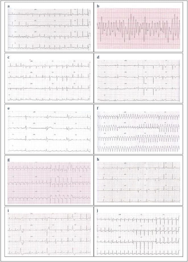 A composite clinical diagnostic image featuring ten labeled electrocardiogram (ECG) strips (A–J) demonstrating various cardiac rhythms and conduction patterns for educational assessment. Panel A shows a standard sinus rhythm with clearly defined P waves, QRS complexes, and T waves. Panel B displays a chaotic, high-frequency, disorganized waveform characteristic of ventricular fibrillation. Panel C exhibits sinus rhythm with occasional premature beats. Panel D and E illustrate bradycardic rhythms with wide QRS complexes and irregular R-R intervals, suggestive of bundle branch blocks or junctional rhythms. Panel F shows a rapid, regular wide-complex tachycardia indicative of ventricular tachycardia. Panel G demonstrates an irregular rhythm with saw-tooth baseline patterns typical of atrial flutter with variable conduction. Panels H, I, and J show variations in ST-segment elevation, pathological Q waves, and narrow-complex tachyarrhythmias. This visual comparison serves as a diagnostic tool for identifying life-threatening arrhythmias, myocardial infarction, and heart blocks in emergency medical services training.