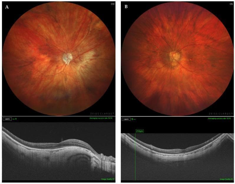 Educational diagnostic comparison of two highly myopic eyes (OD and OS) featuring fundus photography and structural Optical Coherence Tomography (OCT). Panel A displays the right eye (OD) of a 70-year-old patient with an axial length of 29.21 mm. The fundus image shows a tessellated pattern characteristic of high myopia, a pale, well-defined optic disc, and peripapillary atrophy. The corresponding OCT B-scan demonstrates a normal retinal profile despite the elongated globe. Panel B displays the left eye (OS) of a 62-year-old patient with an axial length of 29.75 mm. The fundus reveals a similar tessellated appearance and clear retinal vasculature. The sub-adjacent OCT shows preserved foveal architecture and retinal layer integrity, with a caliper measurement of 212µm indicating local retinal thickness. The images illustrate types of non-macular posterior staphyloma (PS) in high myopia where the macula remains structurally intact on OCT despite significant axial elongation and global pathology.