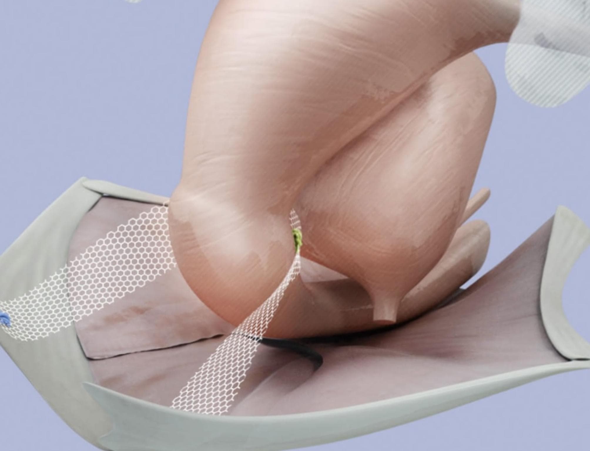 This medical illustration depicts a bilateral sacrospinous colposuspension (BSC) procedure for pelvic organ prolapse (POP) repair. The diagram features a translucent anatomical model of the uterus and cervix in a vertical orientation. A synthetic, white, macroporous mesh with a distinct hexagonal pattern is shown providing apical support. The mesh is anchored bilaterally, extending from the cervical region to simulate the function of natural pelvic ligaments (uterosacral and cardinal ligaments). This surgical setup illustrates the symmetrical suspension of the uterus to the sacrospinous ligaments, intended to recreate a stable pelvic floor and correct apical descent. The illustration is designed for surgical education, highlighting the interaction between prosthetic mesh material and gynecological structures in minimally invasive urogynecological reconstruction.