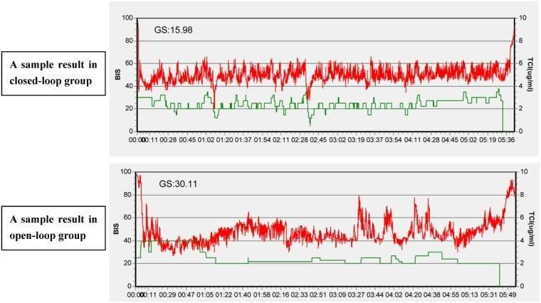 This medical comparison chart illustrates the trends of Bispectral Index (BIS) and target-controlled infusion (TCI) of propofol during anesthesia in two different clinical groups: closed-loop and open-loop systems. The visual content consists of two time-series graphs with time on the x-axis, BIS values (0-100) on the left y-axis, and propofol concentration (μg/ml) on the right y-axis. The red line represents the BIS trend, while the green line indicates the calculated propofol target concentration. In the closed-loop group (top graph, GS=15.98), the BIS values demonstrate greater stability, fluctuating within a narrow target range of 40-60 throughout the induction and maintenance phases. The propofol concentration shows frequent, small adjustments, suggesting responsive automated titration. In contrast, the open-loop group (bottom graph, GS=30.11) exhibits larger oscillations in BIS values and less frequent propofol dosage adjustments, characterized by longer periods of steady-state infusion despite BIS drift. This comparison highlights the efficiency of closed-loop anesthetic delivery in maintaining a consistent depth of anesthesia and reducing glycemic variability or hemodynamic instability associated with over- or under-sedation.