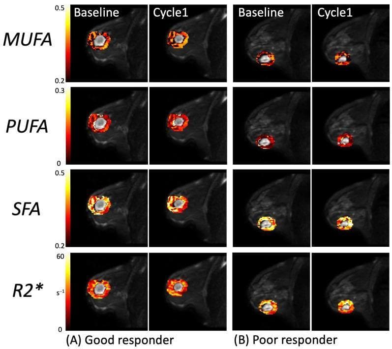 This diagnostic comparison chart displays sagittal quantitative MRI maps of a human breast, focusing on peritumoral metabolic and physiological markers during neoadjuvant chemotherapy (NACT). The image is organized into a grid comparing a 'Good responder' (A) and a 'Poor responder' (B) across two time points: Baseline and Cycle 1. Four key biomarkers are mapped in rows: Monounsaturated Fatty Acids (MUFA), Polyunsaturated Fatty Acids (PUFA), Saturated Fatty Acids (SFA), and the R2* relaxation rate (an indicator of tissue hypoxia). The quantitative data is presented as color-coded heatmaps (ranging from black/red to yellow/white for higher intensity) overlaid onto anatomical MRI scans. In the 'Good responder' columns, there is a visible reduction in the spatial extent and color intensity of all fatty acid markers and R2* signal from baseline to Cycle 1, suggesting a positive metabolic and oxygenation response to treatment. Conversely, the 'Poor responder' exhibits more stable signal intensities and distribution patterns between the two time points. This visual comparison illustrates the potential of peritumoral lipid composition and hypoxia imaging as predictive biomarkers for clinical response in breast cancer oncology.