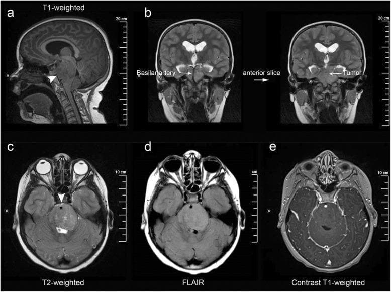 Multi-modal MRI series of the brain demonstrating a Diffuse Intrinsic Pontine Glioma (DIPG). (a) T1-weighted sagittal view shows an infiltrative, expansile mass centered within the pons. (b) Coronal T2-weighted images reveal the exophytic tumor portion extending into the prepontine and suprasellar cisterns, notably encasing the basilar artery. (c-e) Axial sequences highlight characteristic signal patterns: the lesion is hyperintense on T2-weighted (c) and Fluid-Attenuated Inversion Recovery (FLAIR) (d) sequences, indicating significant vasogenic edema or tumor infiltration. (e) Post-gadolinium T1-weighted axial sequence shows a conspicuous absence of enhancement, a typical feature of DIPG indicating an intact blood-brain barrier within the tumor. Associated secondary findings include obstructive hydrocephalus, evidenced by dilated lateral ventricles in the coronal views. This imaging series illustrates the classic neuroradiological criteria for pediatric brainstem gliomas, emphasizing anatomical distortion of the brainstem, cisternal extension, and specific signal characteristics across varying MRI sequences.